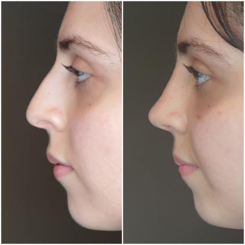 Rinoplastia ultrasónica Fotos del antes y el después